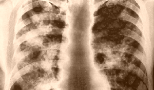 silica-lungs-xray-01-vintage